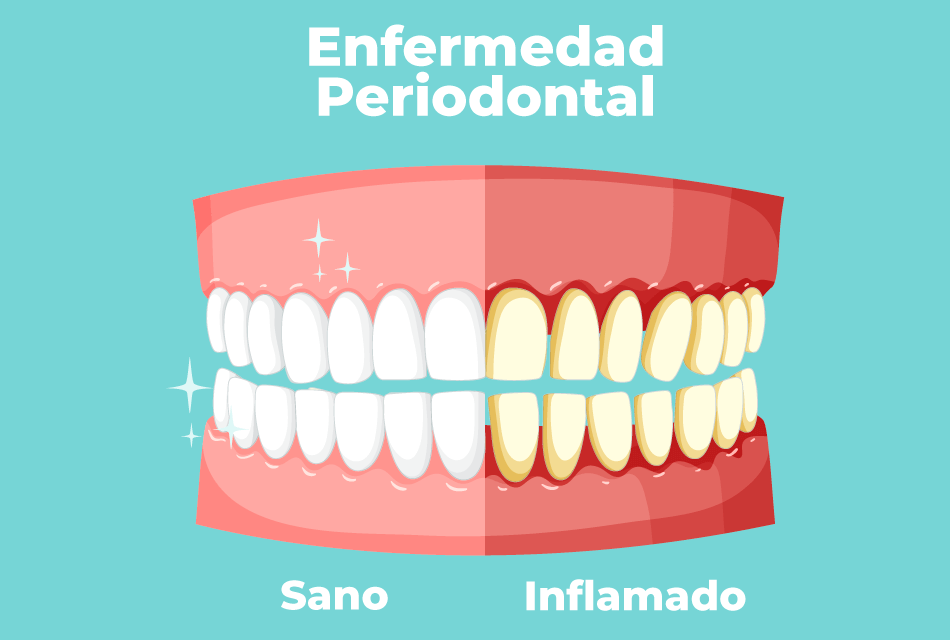 ¿Qué es la enfermedad periodontal?
